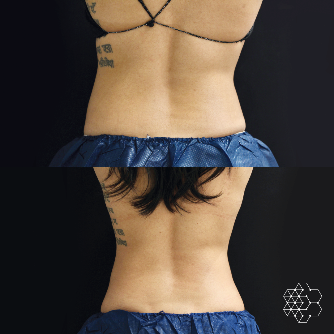 CoolSculpting - Buy 2, Get 2 at 50% Off!