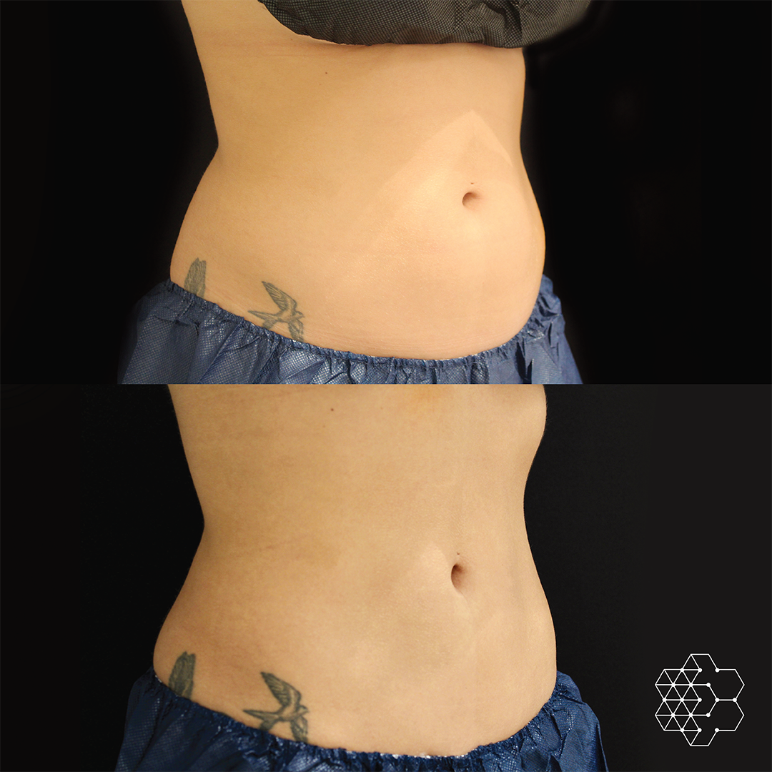 CoolSculpting - Buy 2, Get 2 at 50% Off!