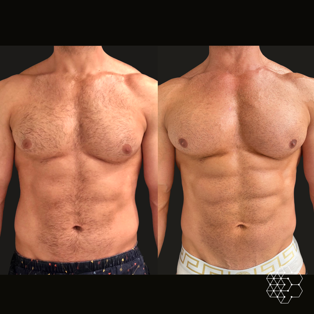 EMSculpt - 25% OFF