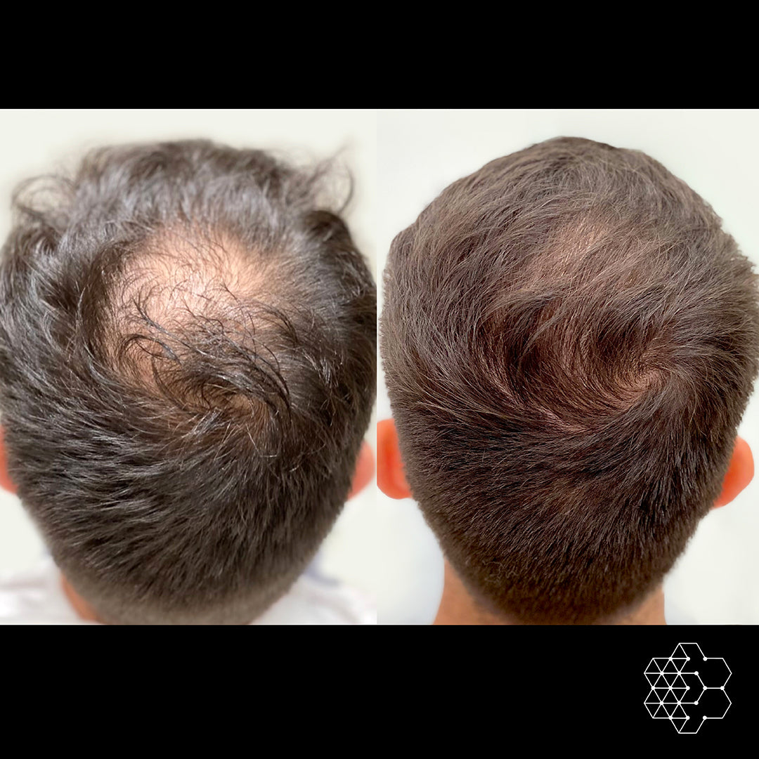 Hair Restoration with Exosomes