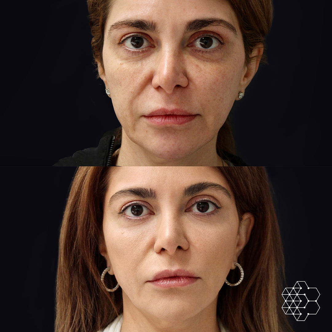 Ultherapy - 20% OFF