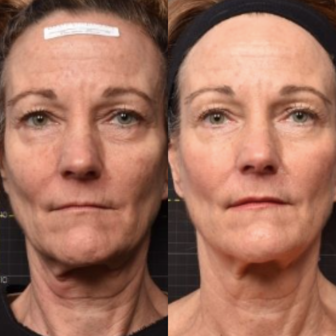 SofWave™ - 25% Off