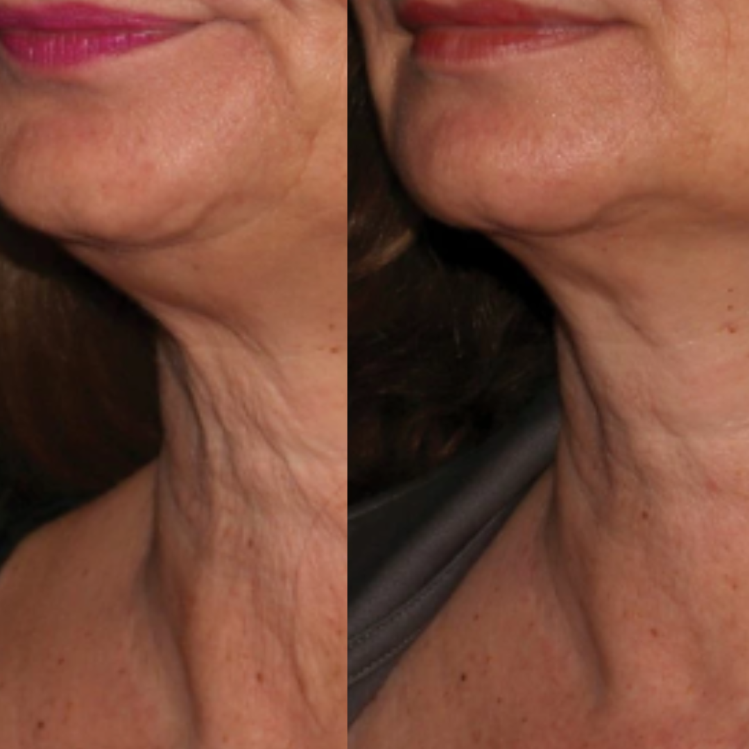 SofWave™ - 25% Off