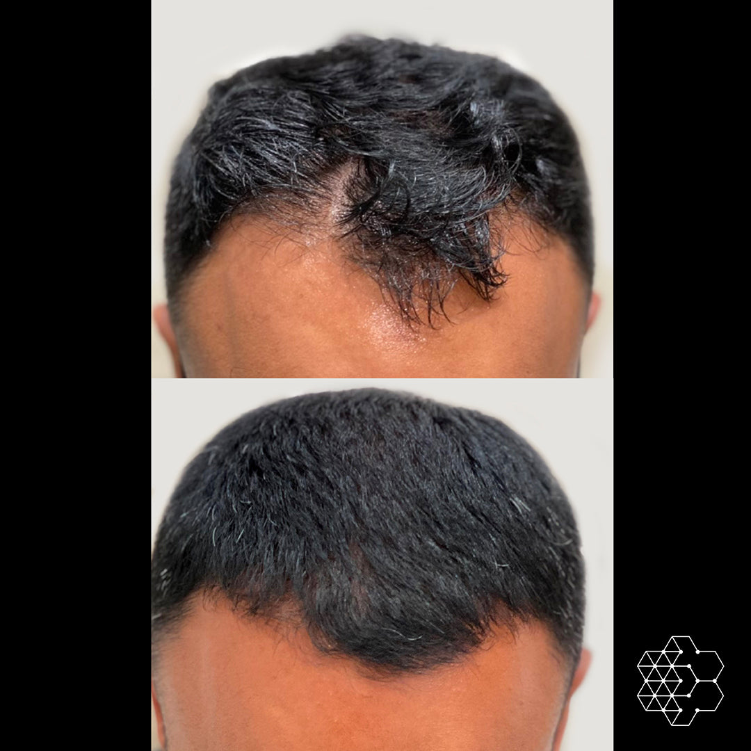 Hair Restoration with Exosomes